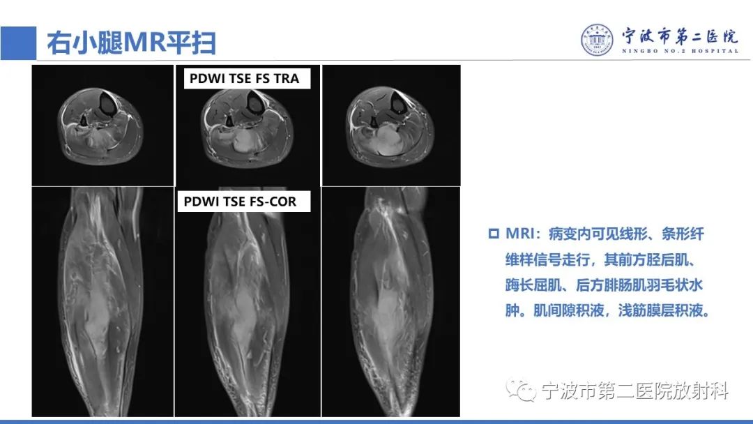 影像PPT - 【PPT】增生性肌炎-7