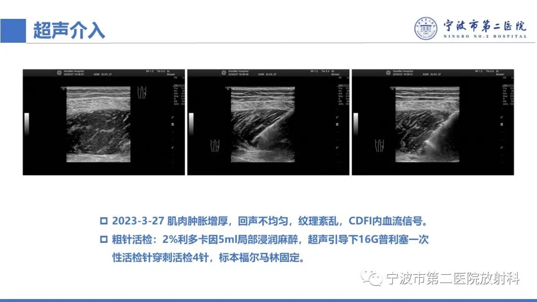 影像PPT - 【PPT】增生性肌炎-15