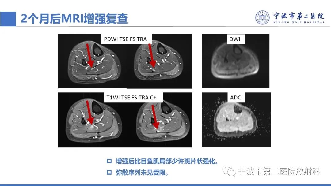影像PPT - 【PPT】增生性肌炎-17