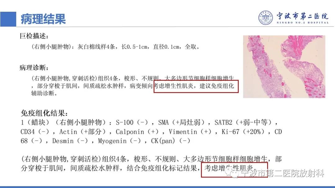 影像PPT - 【PPT】增生性肌炎-16