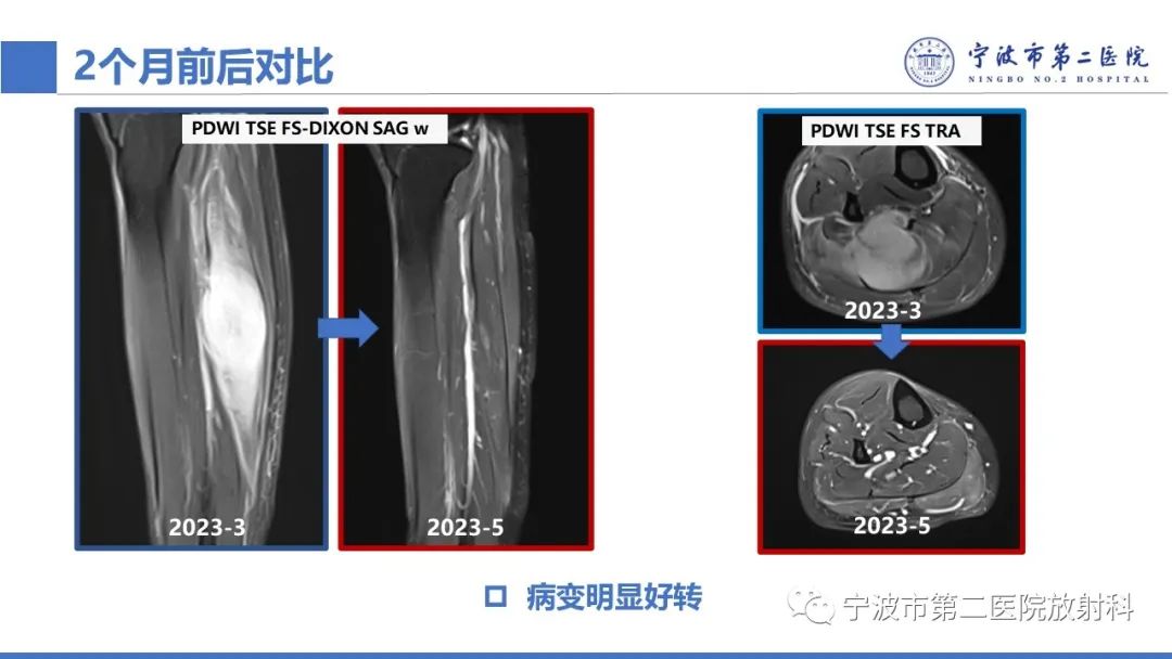 影像PPT - 【PPT】增生性肌炎-18