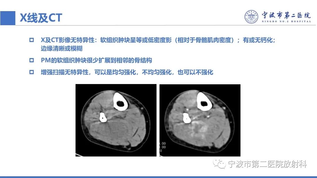 影像PPT - 【PPT】增生性肌炎-21