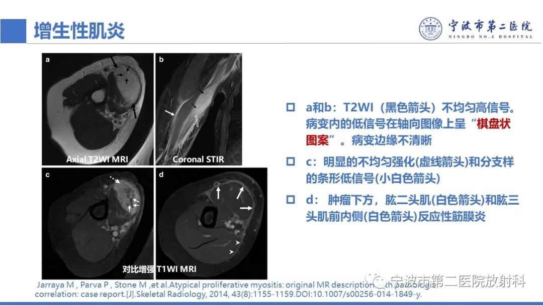 影像PPT - 【PPT】增生性肌炎-23