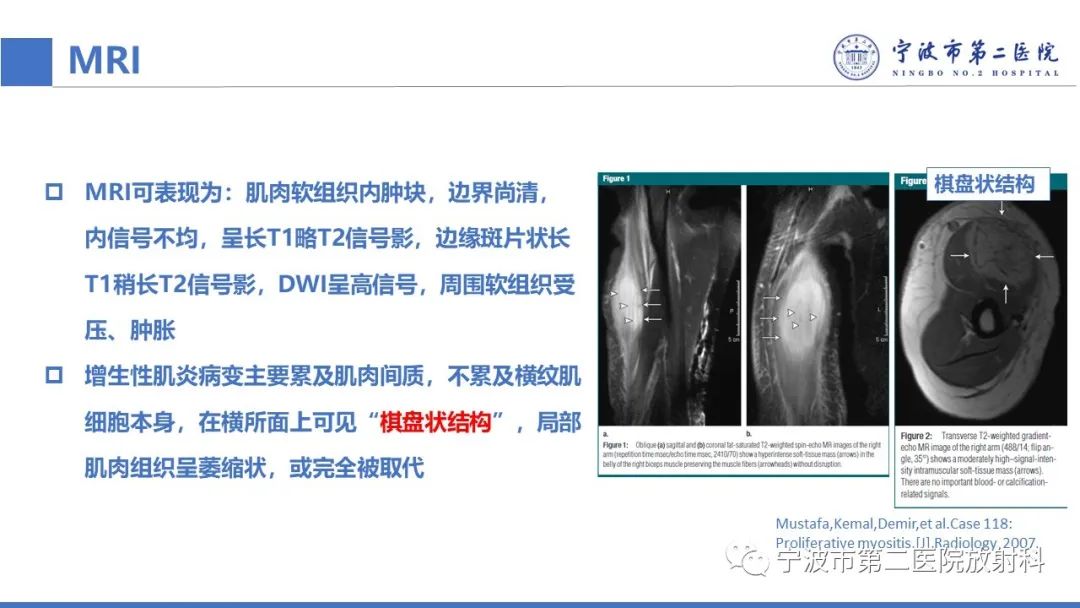 影像PPT - 【PPT】增生性肌炎-22