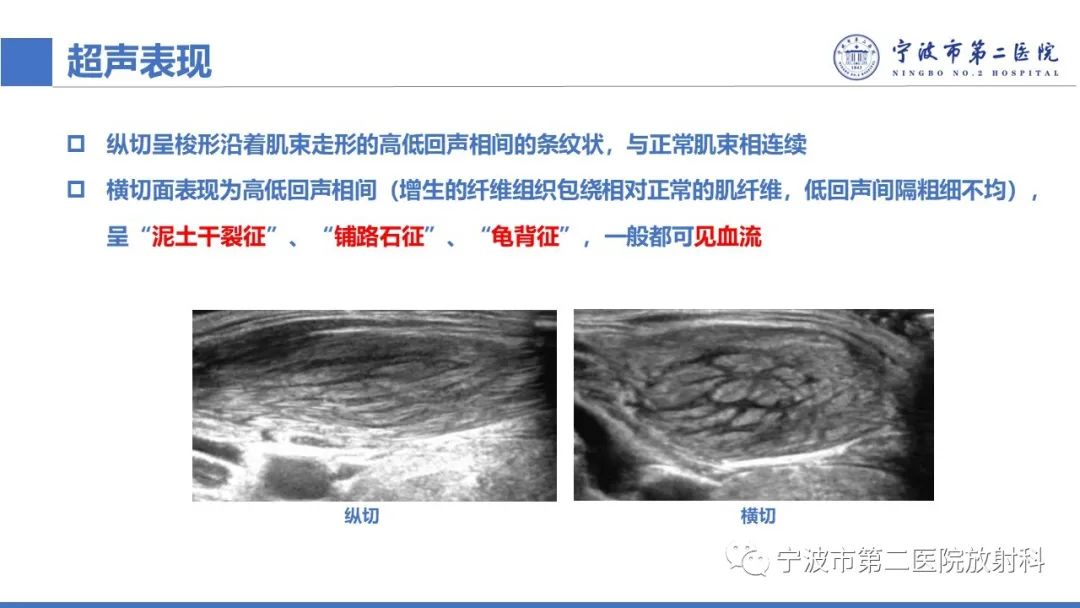 影像PPT - 【PPT】增生性肌炎-24