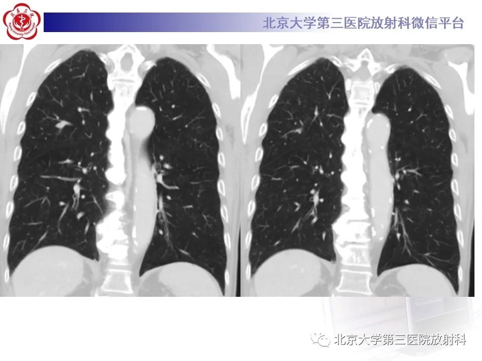 影像PPT - 【PPT】小细胞肺癌-7