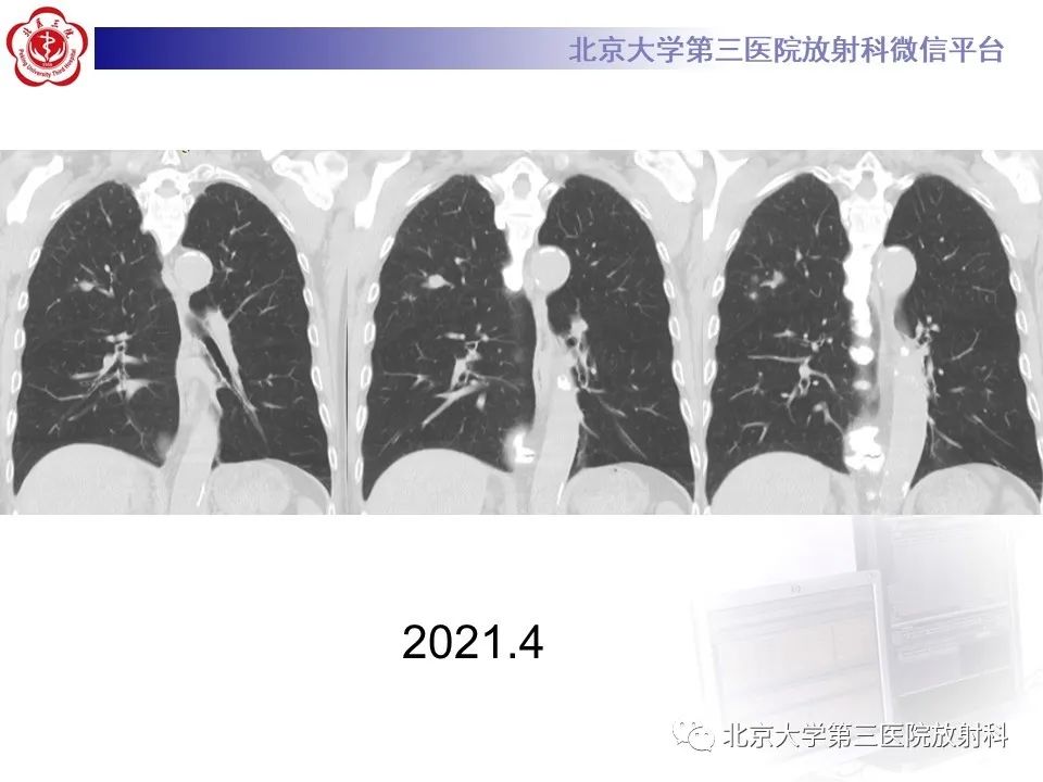 影像PPT - 【PPT】小细胞肺癌-10