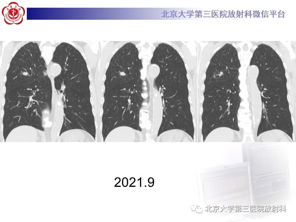 影像PPT - 【PPT】小细胞肺癌-12