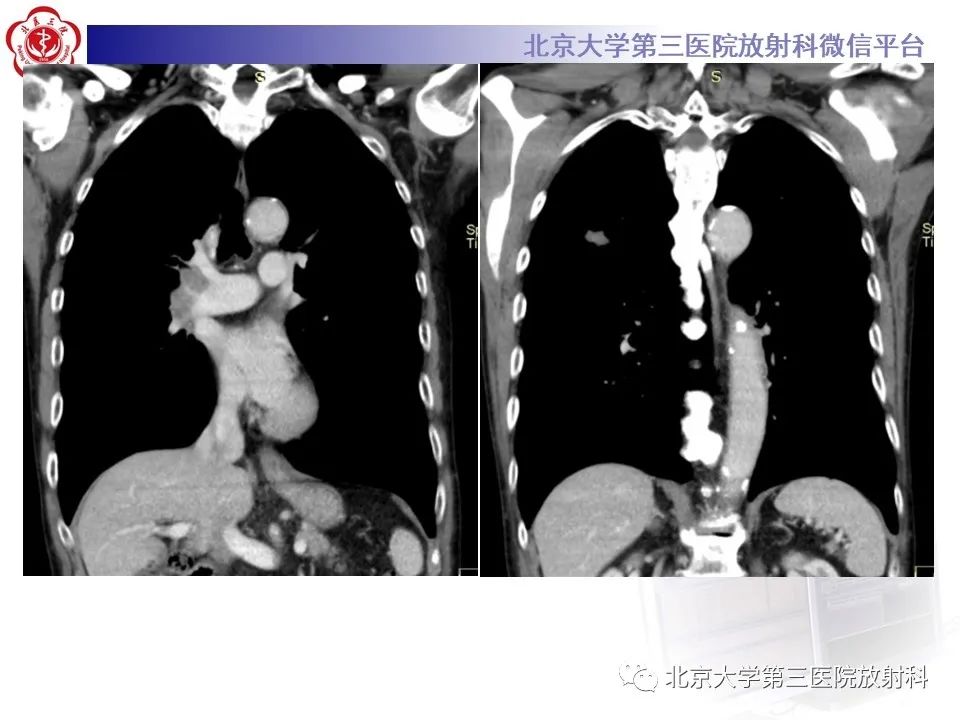 影像PPT - 【PPT】小细胞肺癌-17