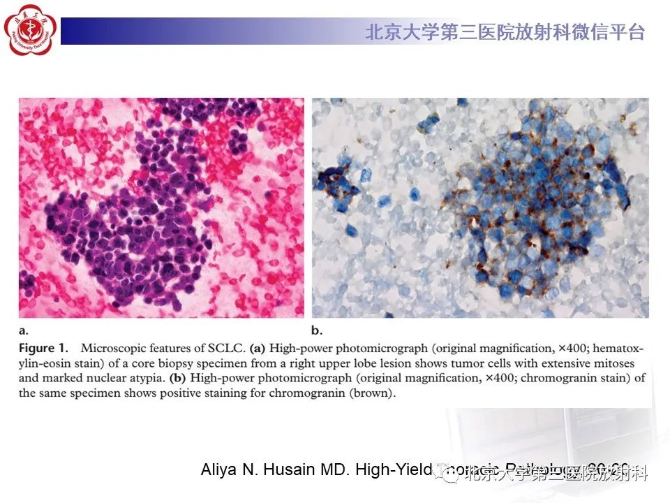 影像PPT - 【PPT】小细胞肺癌-24