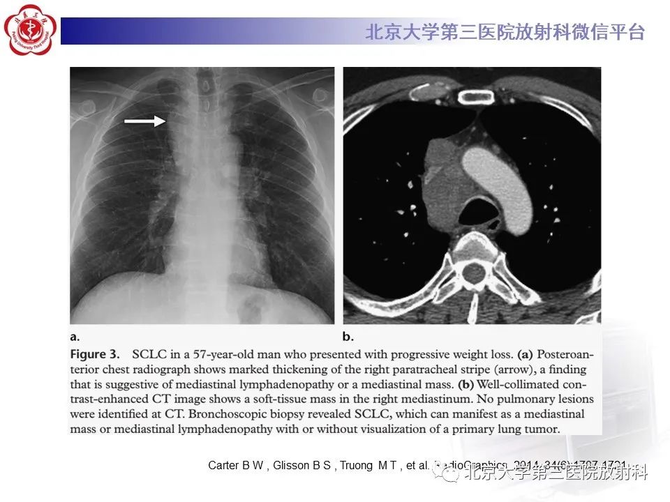 影像PPT - 【PPT】小细胞肺癌-28