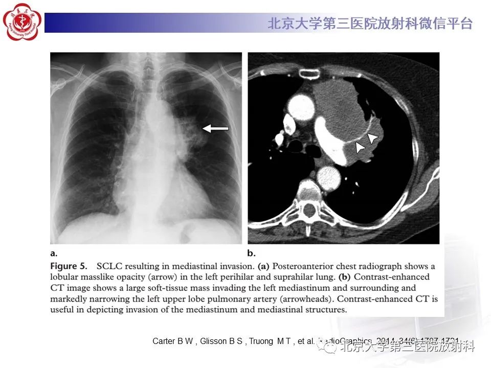 影像PPT - 【PPT】小细胞肺癌-29