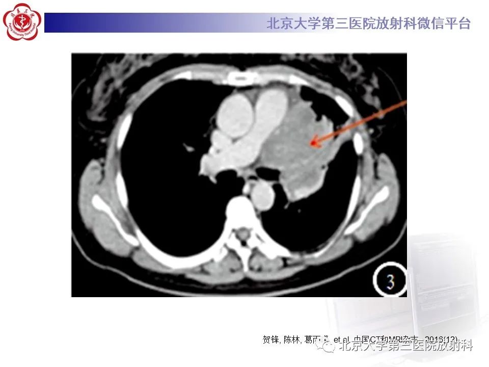 影像PPT - 【PPT】小细胞肺癌-31