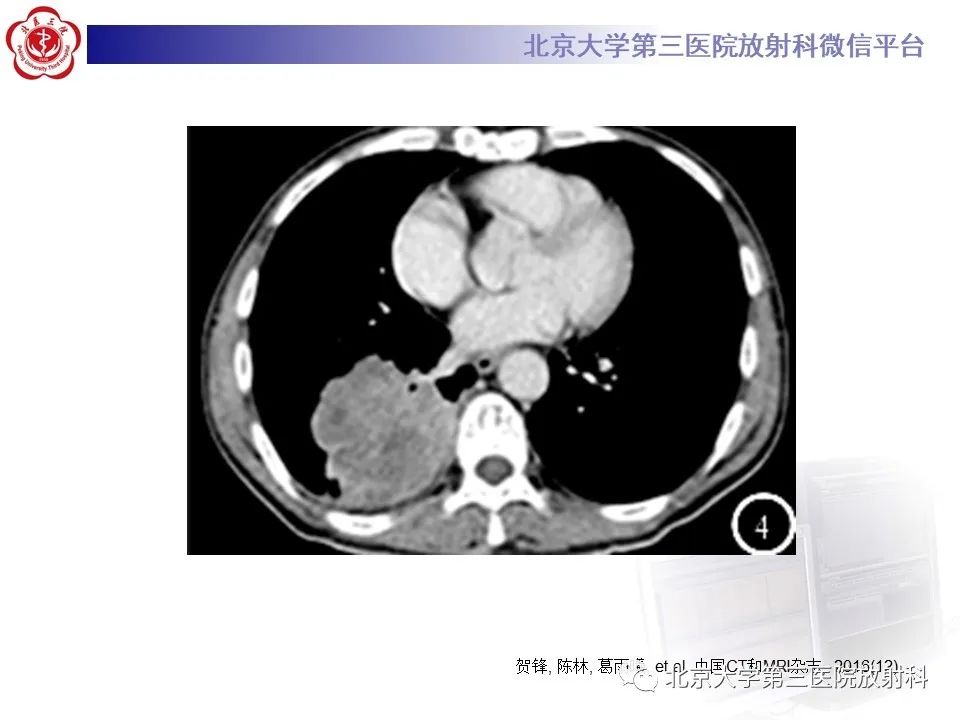 影像PPT - 【PPT】小细胞肺癌-32