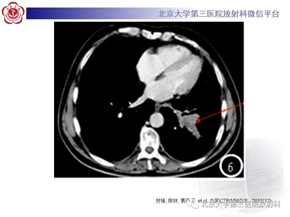 影像PPT - 【PPT】小细胞肺癌-33