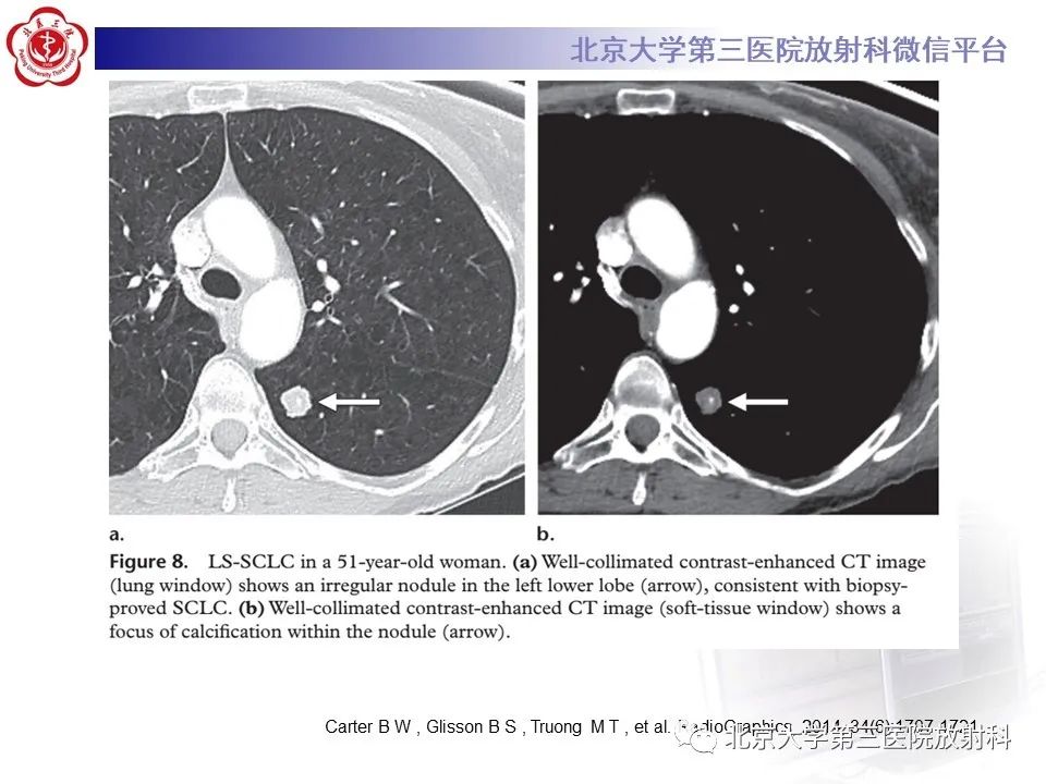 影像PPT - 【PPT】小细胞肺癌-35
