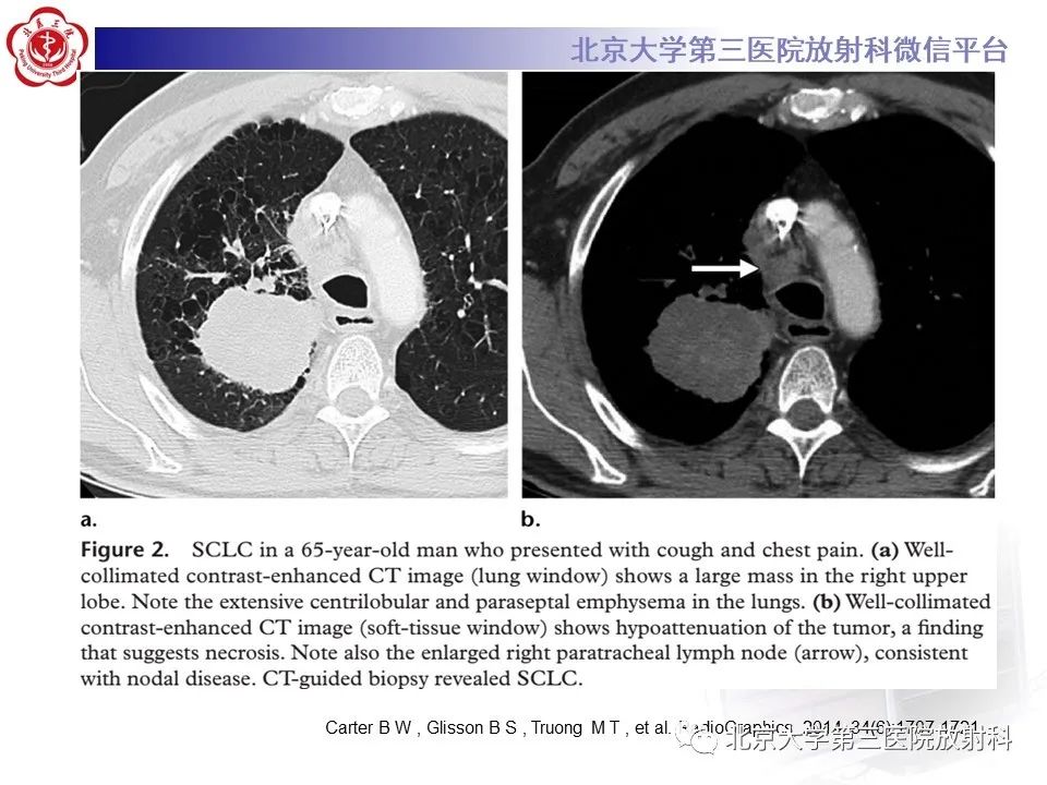 影像PPT - 【PPT】小细胞肺癌-36