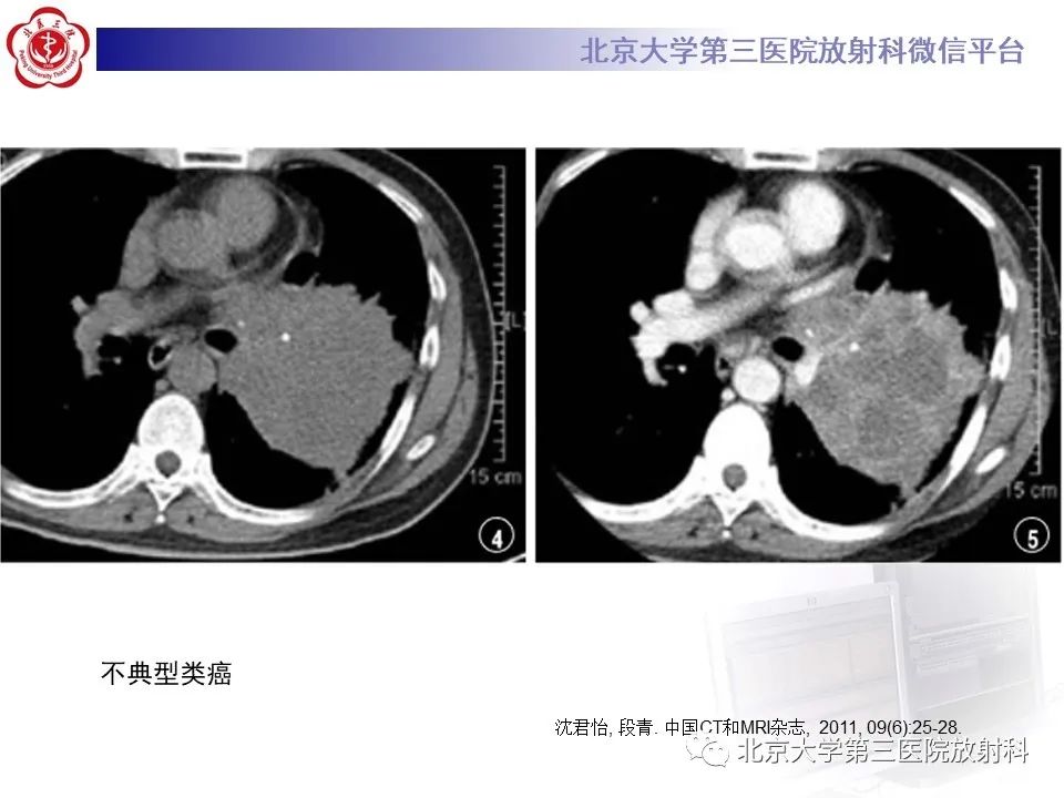 影像PPT - 【PPT】小细胞肺癌-40