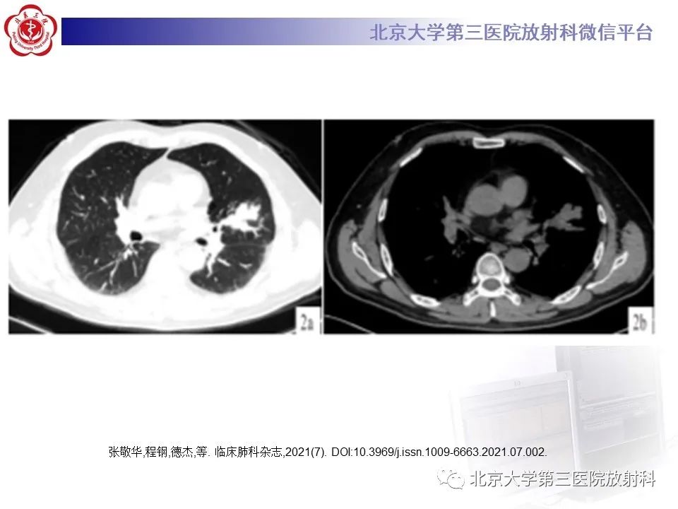 影像PPT - 【PPT】小细胞肺癌-42