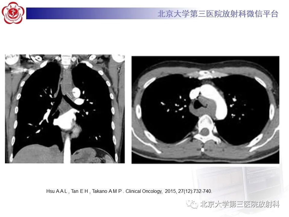 影像PPT - 【PPT】小细胞肺癌-44