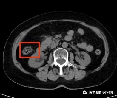 影像PPT - 肠壁“脂肪晕征”-2 影像PPT - 肠壁“脂肪晕征”-2
