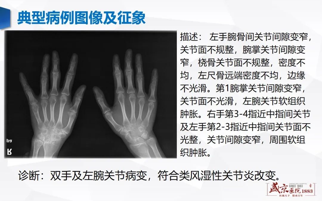 影像PPT - 【病例】类风湿性关节炎 & 强直性脊柱炎 & 痛风性关节炎-4