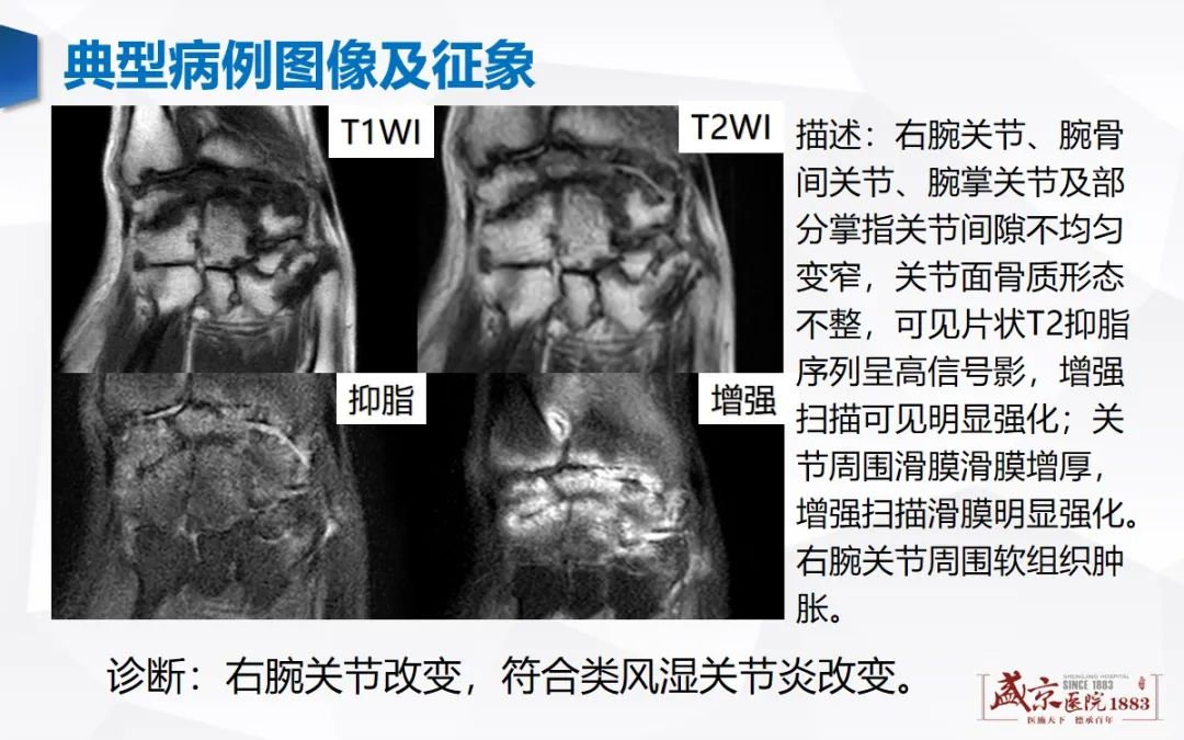 影像PPT - 【病例】类风湿性关节炎 & 强直性脊柱炎 & 痛风性关节炎-5