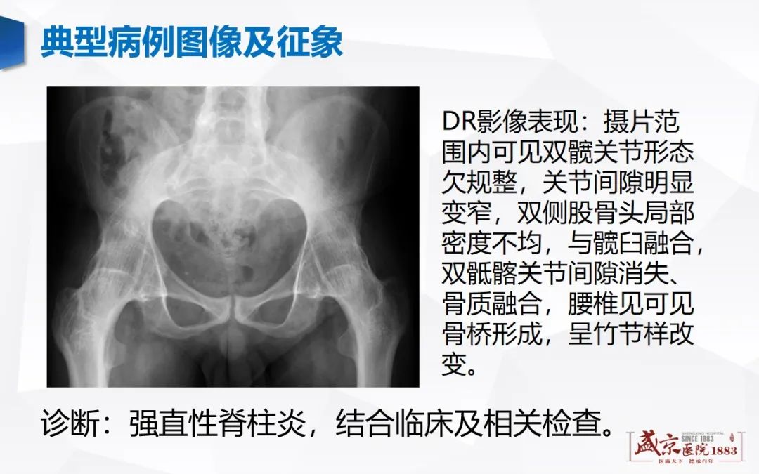 影像PPT - 【病例】类风湿性关节炎 & 强直性脊柱炎 & 痛风性关节炎-11