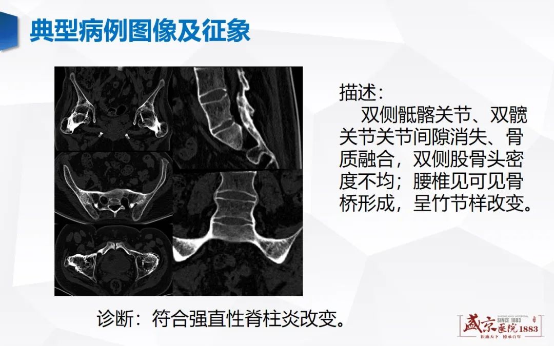 影像PPT - 【病例】类风湿性关节炎 & 强直性脊柱炎 & 痛风性关节炎-12