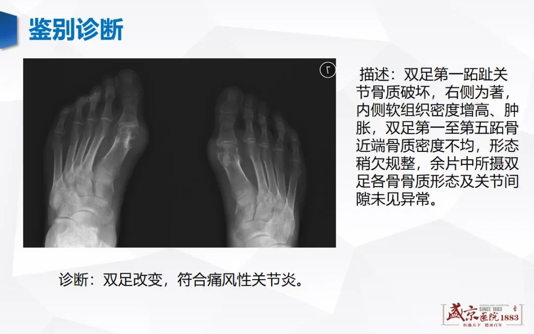 影像PPT - 【病例】类风湿性关节炎 & 强直性脊柱炎 & 痛风性关节炎-19