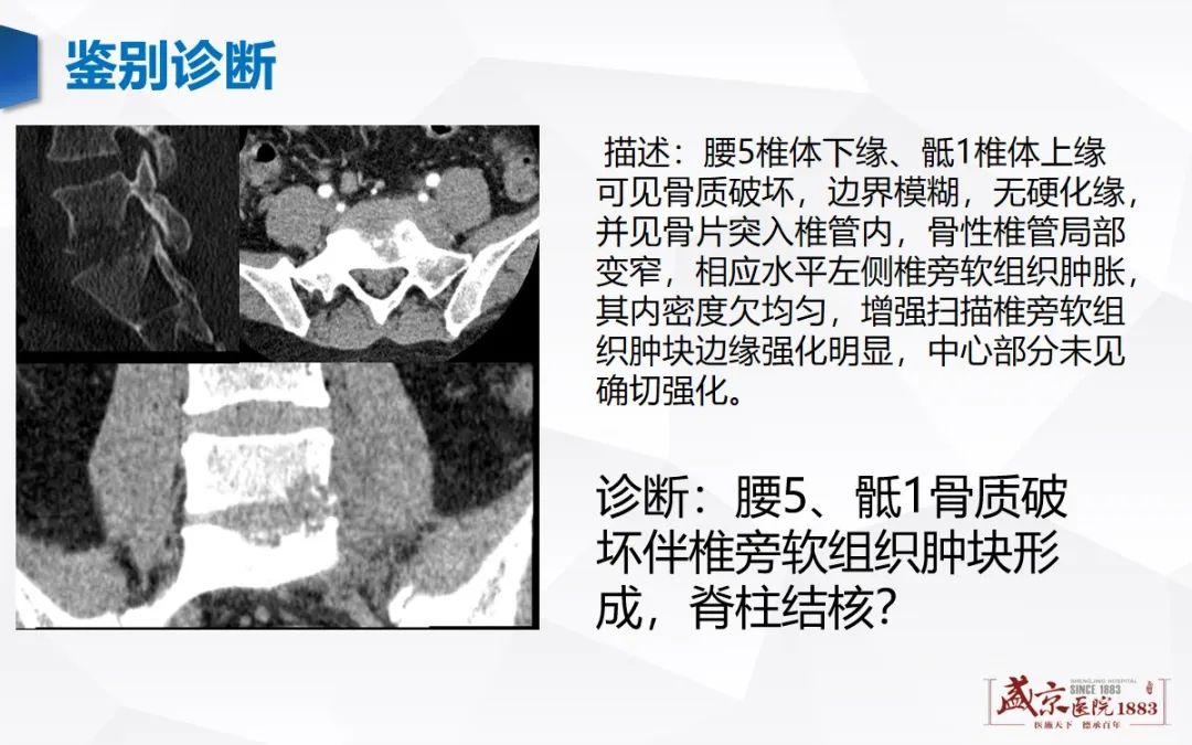 影像PPT - 【病例】类风湿性关节炎 & 强直性脊柱炎 & 痛风性关节炎-22