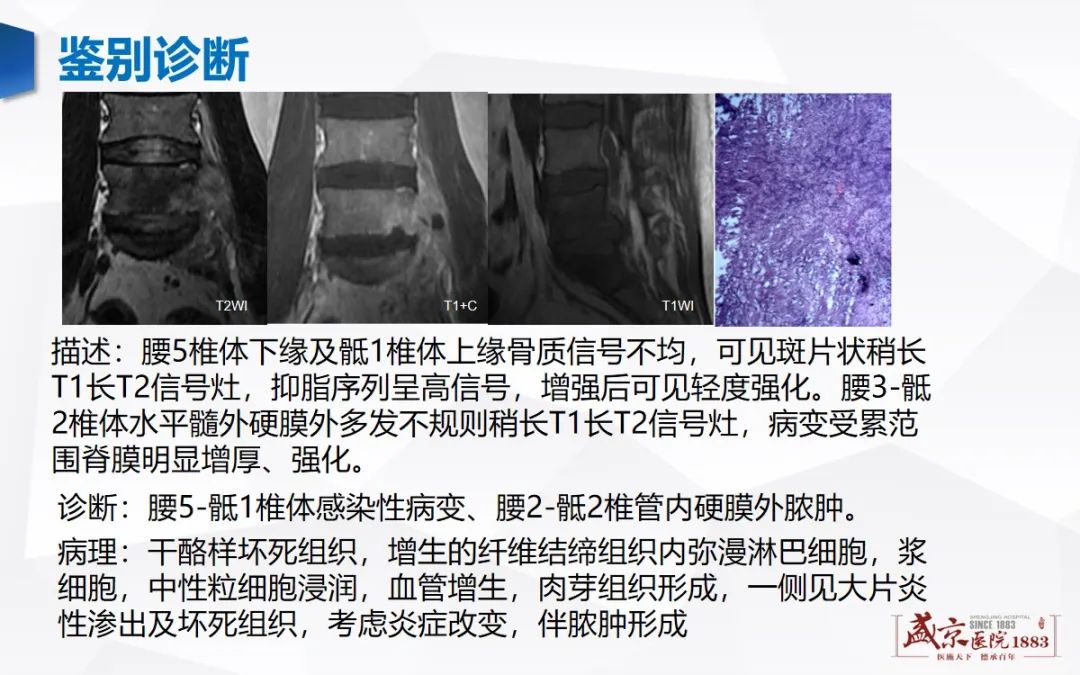 影像PPT - 【病例】类风湿性关节炎 & 强直性脊柱炎 & 痛风性关节炎-23