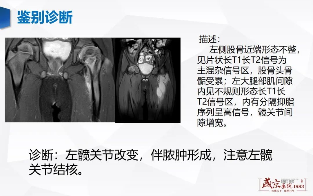 影像PPT - 【病例】类风湿性关节炎 & 强直性脊柱炎 & 痛风性关节炎-26