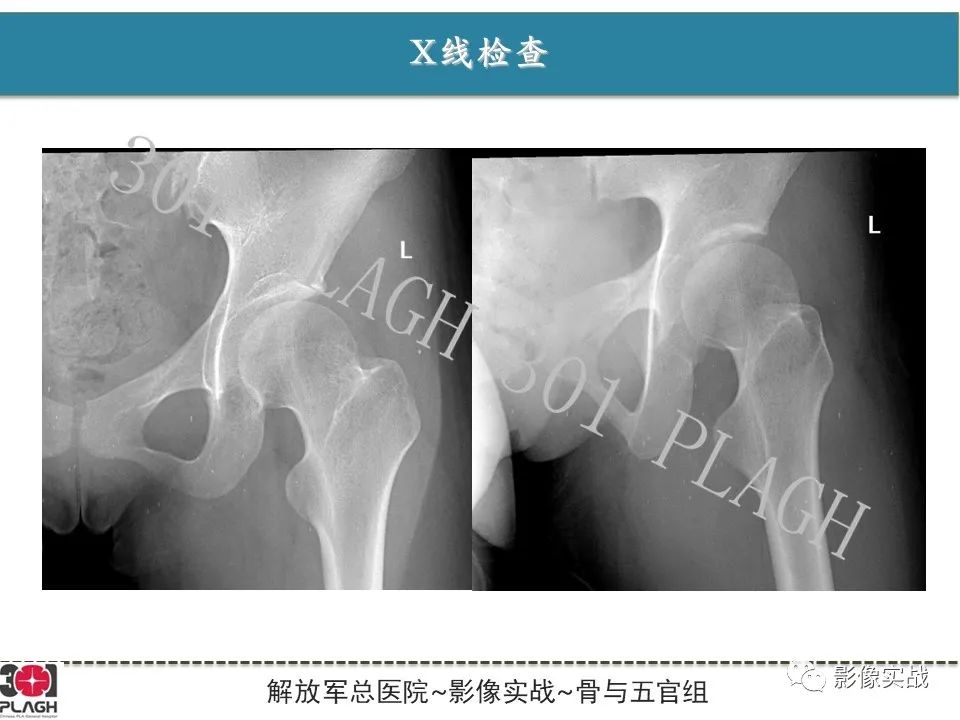 影像PPT - 【病例】股骨尤文氏肉瘤1例X线MR影像-3