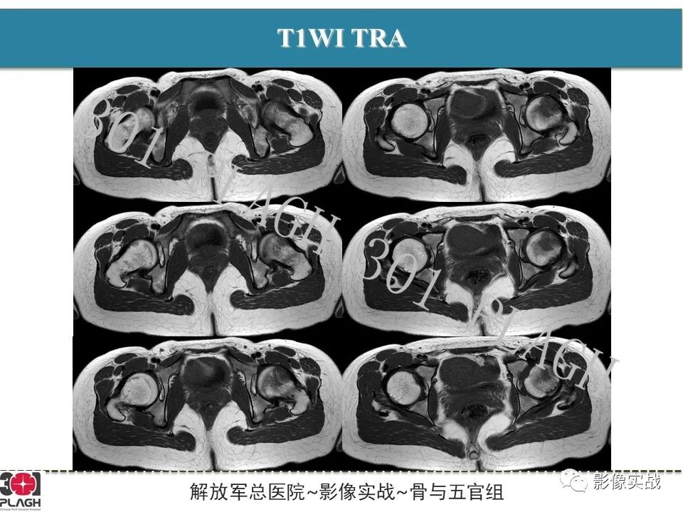 影像PPT - 【病例】股骨尤文氏肉瘤1例X线MR影像-4