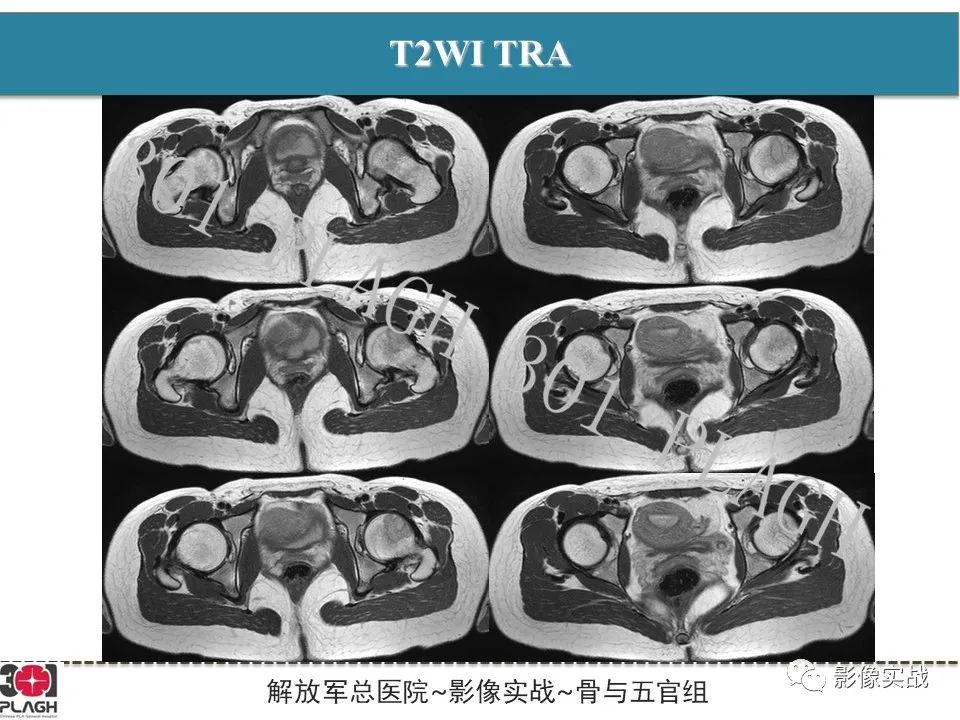 影像PPT - 【病例】股骨尤文氏肉瘤1例X线MR影像-5
