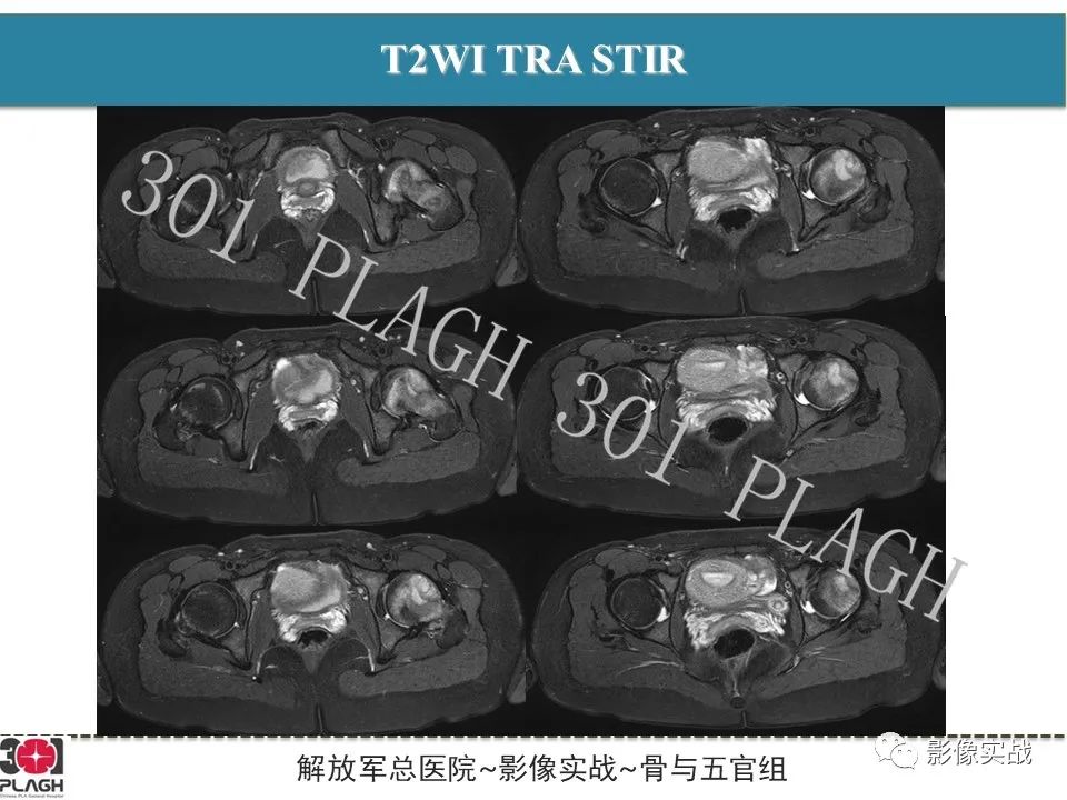 影像PPT - 【病例】股骨尤文氏肉瘤1例X线MR影像-6