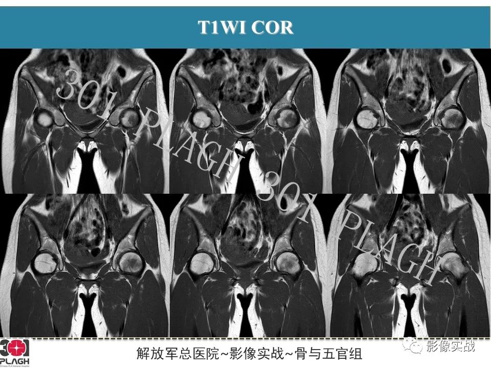 影像PPT - 【病例】股骨尤文氏肉瘤1例X线MR影像-8