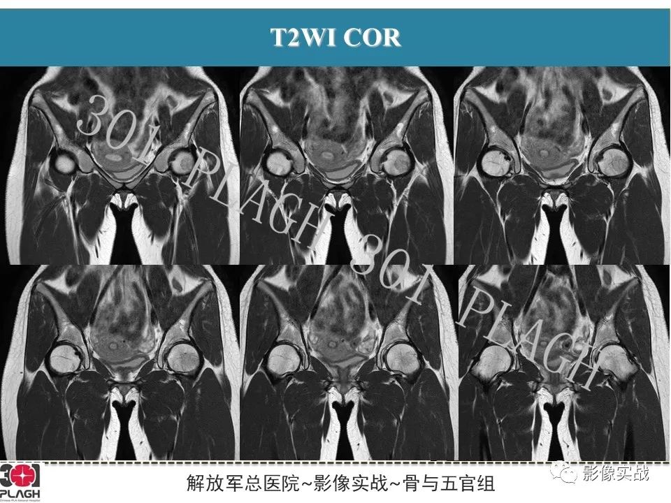 影像PPT - 【病例】股骨尤文氏肉瘤1例X线MR影像-9