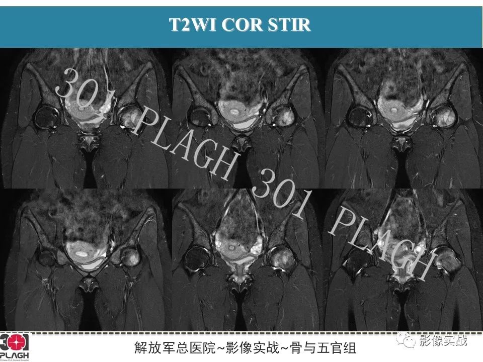 影像PPT - 【病例】股骨尤文氏肉瘤1例X线MR影像-10