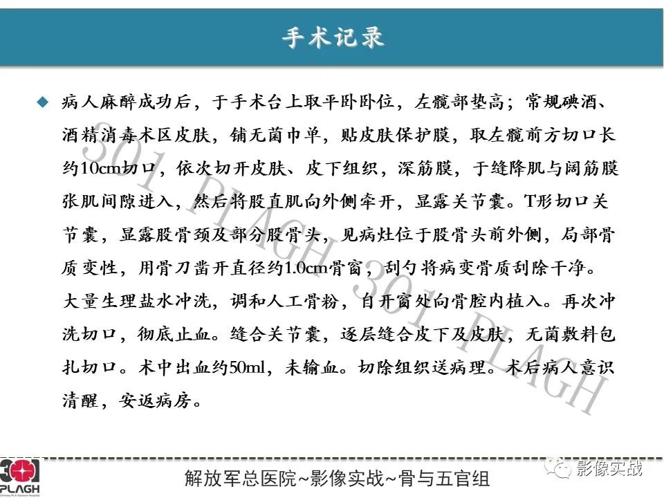 影像PPT - 【病例】股骨尤文氏肉瘤1例X线MR影像-12