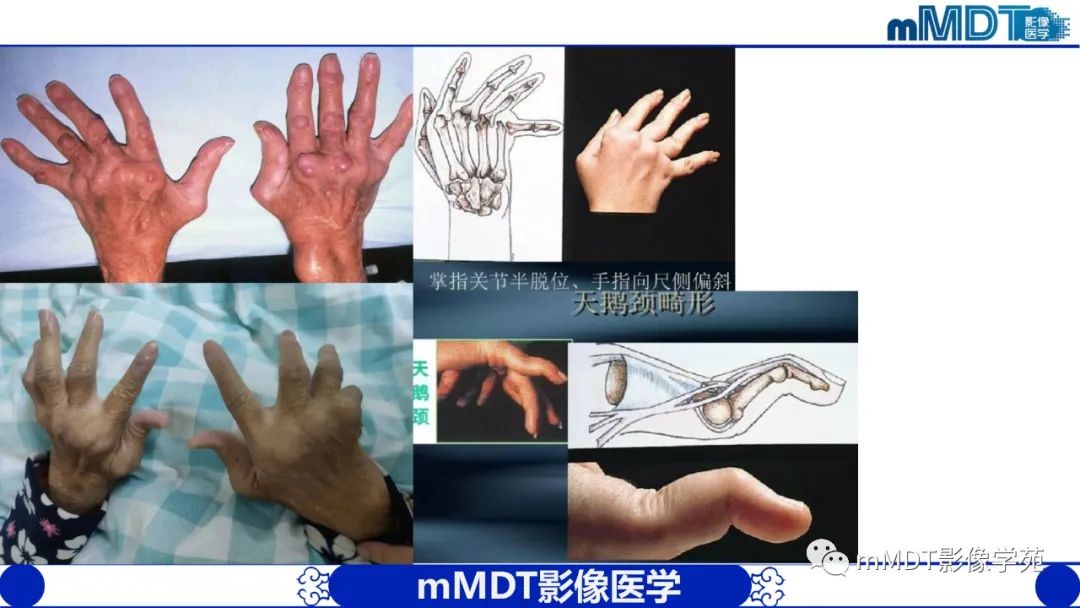 影像PPT - 【PPT】类风湿关节炎的影像诊断-4