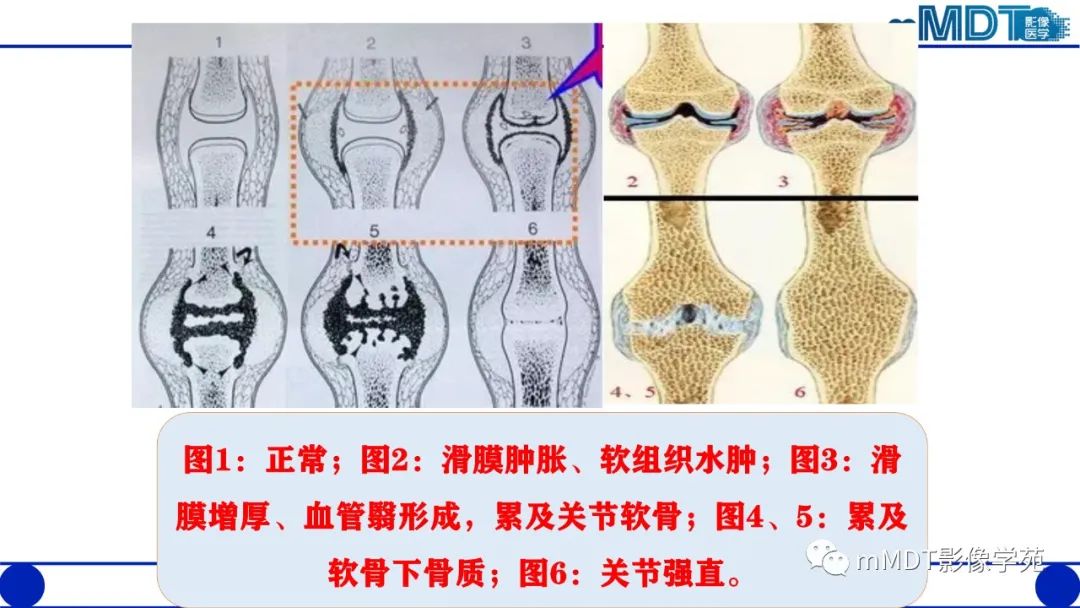 影像PPT - 【PPT】类风湿关节炎的影像诊断-9