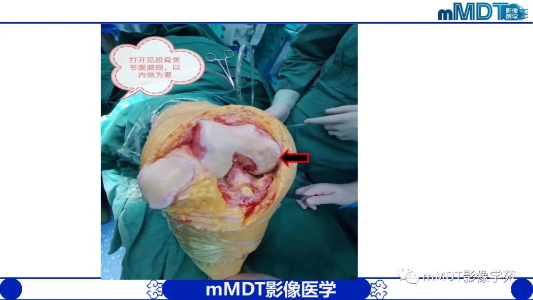 影像PPT - 【PPT】类风湿关节炎的影像诊断-11