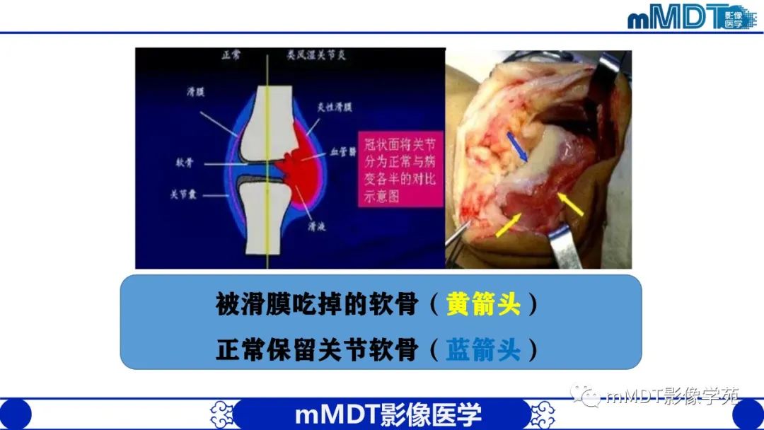 影像PPT - 【PPT】类风湿关节炎的影像诊断-10