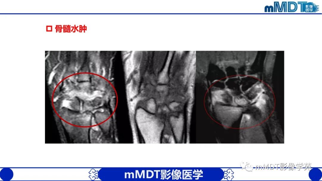 影像PPT - 【PPT】类风湿关节炎的影像诊断-16