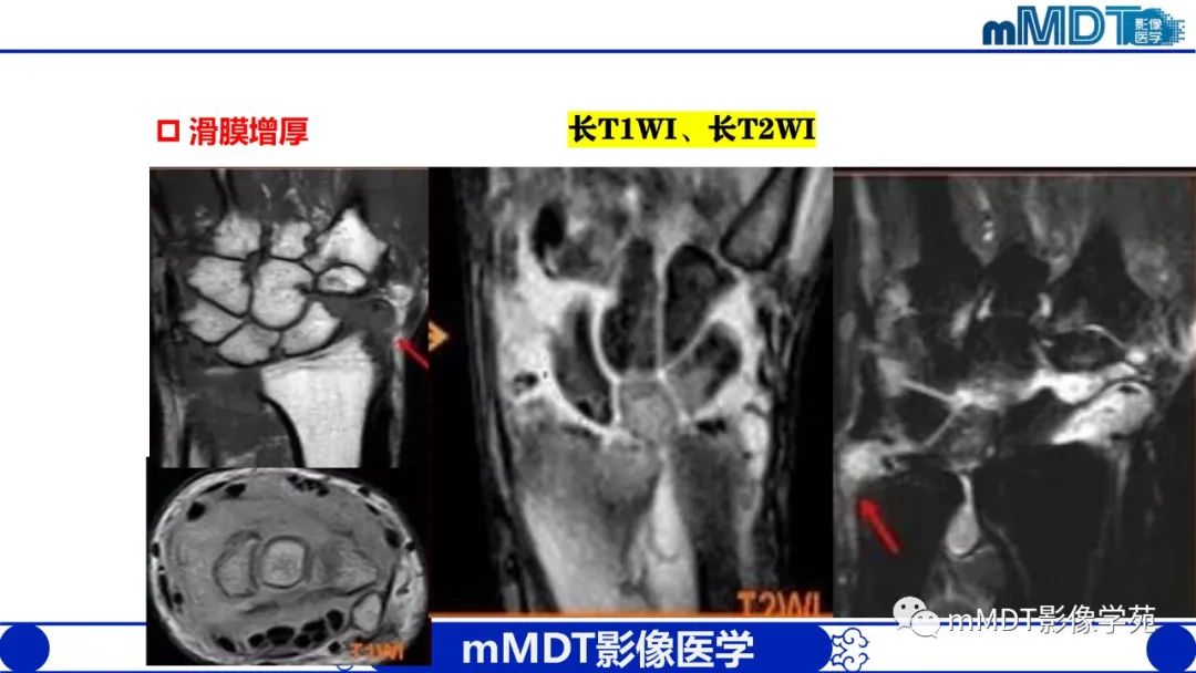 影像PPT - 【PPT】类风湿关节炎的影像诊断-17