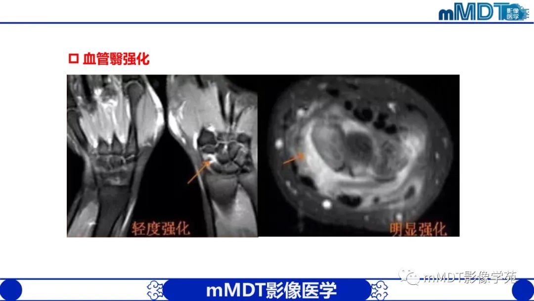 影像PPT - 【PPT】类风湿关节炎的影像诊断-18