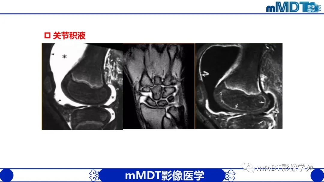 影像PPT - 【PPT】类风湿关节炎的影像诊断-19