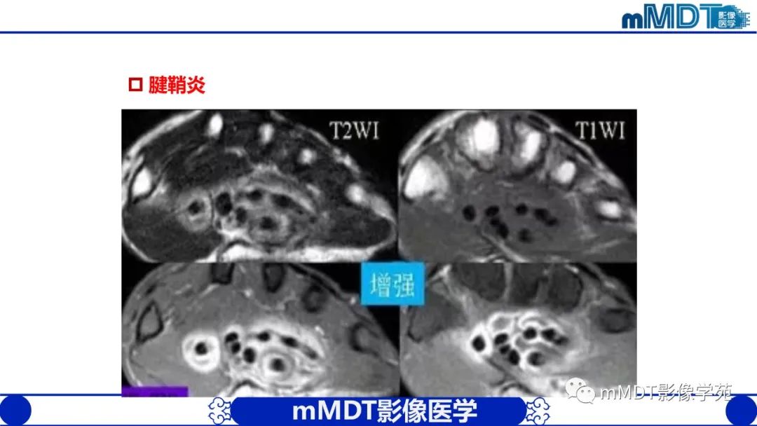 影像PPT - 【PPT】类风湿关节炎的影像诊断-20